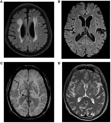 Type A personality, sleep quality, and cerebral small vessel disease: investigating the mediating role of sleep in a community-based study